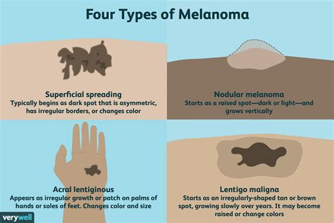 most common treatments for melanoma